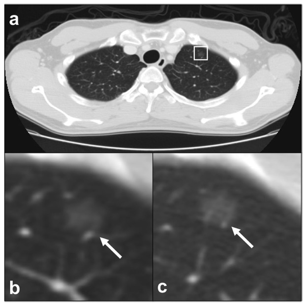 European Radiology：深度学习在自动检测肺结节中的应用