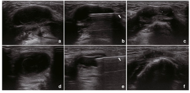 European?Radiology：<font color="red">甲</font>狀<font color="red">舌</font><font color="red">管</font>囊腫該如何進行術(shù)式選擇？乙醇消融治療看一看