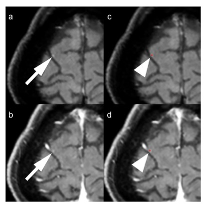 European Radiology：<font color="red">卷积</font><font color="red">神经网络</font>在脑转移瘤自动检测中的应用