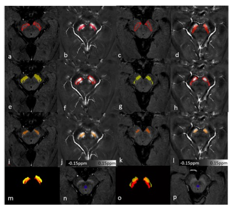 European Radiology：基于QSM的黑质神经<font color="red">黑色素</font>和铁的区域年龄相关变化