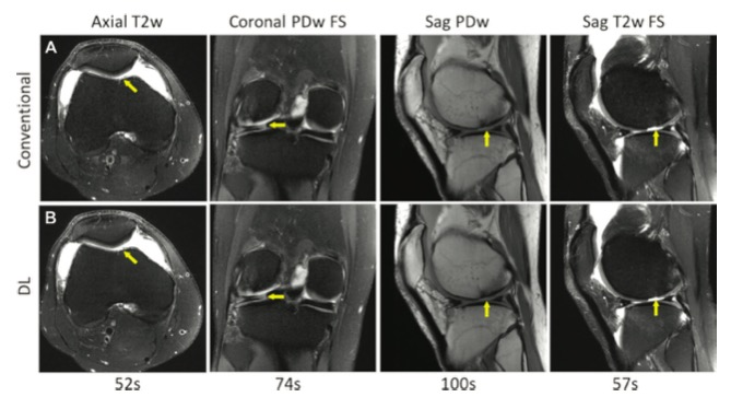 <font color="red">Radiology</font>：深度学习重建实现临床膝关节MRI扫描的加速！