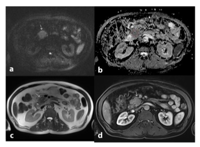 academic radiology：3.0T MRI评价壶腹周围癌的影像学表现