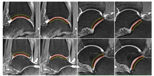 academic radiology：MRI放射组学，实现踝关节结构改变的早期识别！
