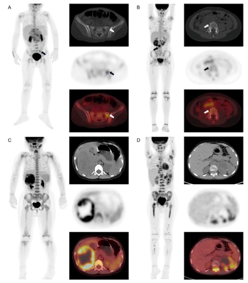 academic radiology：18F-<font color="red">FDG</font> <font color="red">PET</font>/<font color="red">CT</font>放射组学列线图在小儿神经母细胞瘤中的诊断价值