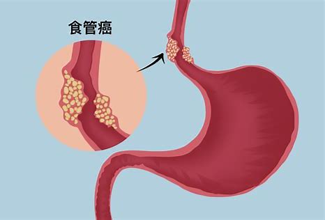 王立东教授：食管癌高发现场防治研究进展