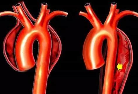Cardiovasc Diabetol：<font color="red">残余</font>胆固醇和主动脉瓣钙化进展风险的关系