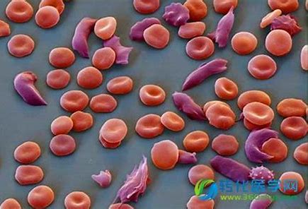 与再生障碍性贫血相鉴别的先天性全血细胞减少症