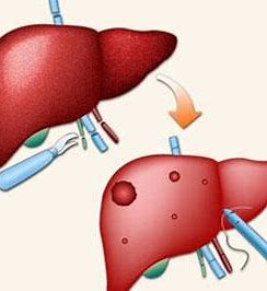 APT：肝脏硬度测定作为一种诊断慢性丁型肝炎病毒感染患者肝硬化的无创方法