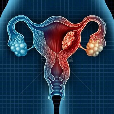 病理干货 | 简述子宫内膜癌的分子分型及临床意义