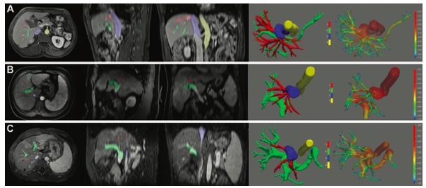 Radiology：基于CT和MRI的诊断临床显著门静脉<font color="red">高压</font>的无创血管模型