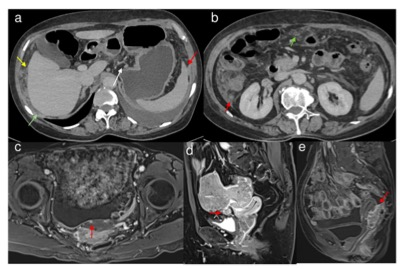 academic radiology：MRI放射组学模型在预测卵巢癌肿瘤残留方面的价值