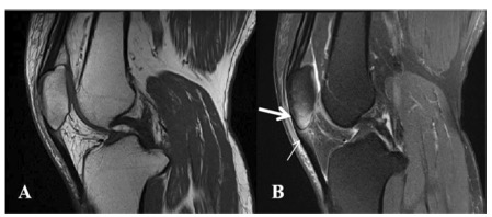 European Radiology：膝关节“滑膜-肌腱复合体”在脊柱关节炎、类风湿关节炎和骨关节炎鉴别诊断中的价值