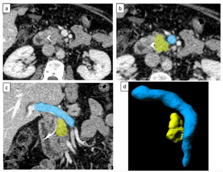 European Radiology：肠系膜-<font color="red">门</font><font color="red">脉</font>轴CT影像学特征对胰腺癌患者生存预测的探索性分析