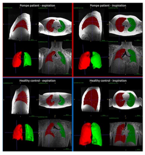 European Radiology：从MR<font color="red">视角</font>看庞贝病的变化！