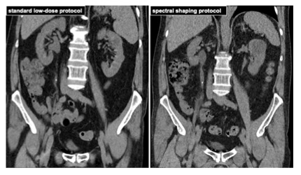 academic radiology：超低剂量腹部CT检测尿路结石的能力及价值
