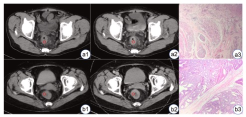 Eur J Radiol:基于CT的细胞外体积<font color="red">分数</font>在直肠腺癌术前病理分级中的预测价值