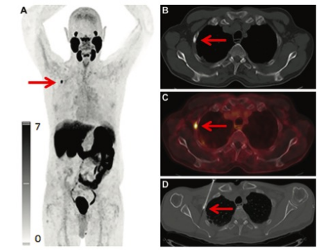 Radiology：PET/CT在<font color="red">前列腺</font>癌骨转移病变识别中的应用