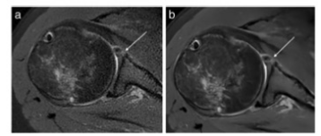 European Radiology：肩关节MR成像的深度学习重建，实现图像的“又好又快”！