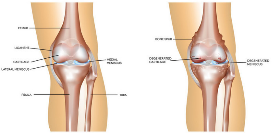 Rheumatology：骨关节炎中的人工智能，膝关节牵张修复显示疼痛、放射学和免疫结果的相关性