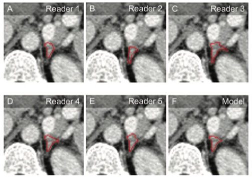 Radiology：机器学习实现肾上腺肿块的全自动分割和<font color="red">分类</font>