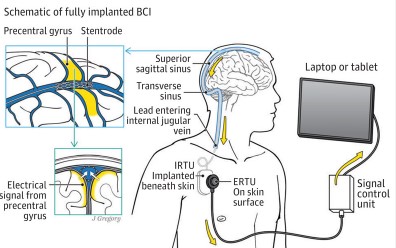 JAMA子刊：完全植入式血管内的脑机接口对4名重度瘫痪患者的安全<font color="red">性</font>评估