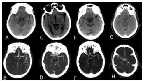 Radiology：CT动脉<font color="red">高密度</font>征对急性脑卒中患者的治疗有何影响？