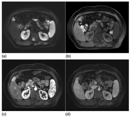 European Radiology：混合型肝细胞癌-胆管癌的MR生存预测