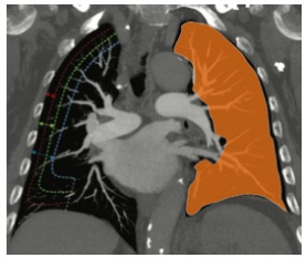Radiology：<font color="red">肺动脉</font>小<font color="red">血管</font>的CT定量评价对<font color="red">肺动脉</font>高压的价值