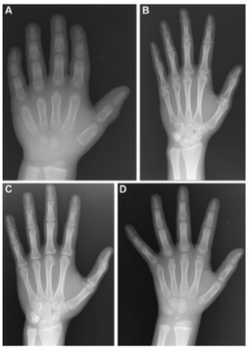 Radiology：使用手X线片的儿童骨龄深度学习模型评估
