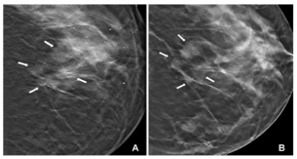 Radiology：相位敏感乳腺断层成形术性能的初步研究