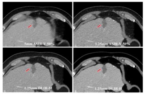 European Radiology：如何提高腹部CT增强扫描的空间分辨率和诊断可信度？