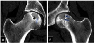 European Radiology：不同阶段的股骨头坏死，MDCT上的骨改变有何特殊临床意义？