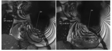 European Radiology：如何减少心脏磁共振成像中植入式电子设备引起的金属伪影？