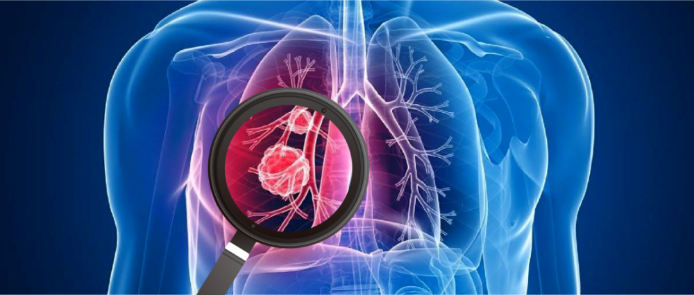 《柳叶刀》重磅综述：肺癌筛查现状与未来方向！