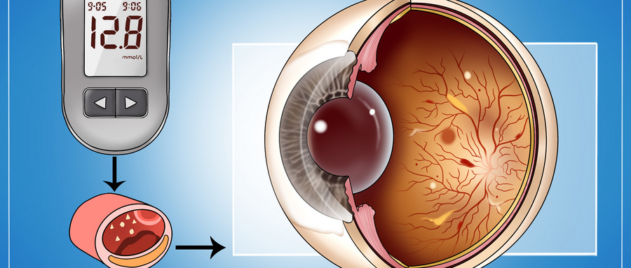 羟<font color="red">氯喹</font>视网膜病变的风险究竟有多大？