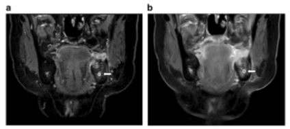 European Radiology：基于压缩感知的增强MRI图像对下颌癌分级诊断的临床价值