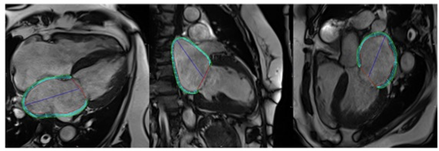 European Radiology：左心房张力与安德森-法布里病心脏受累的严重程度的相关性