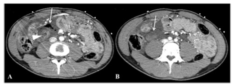 European Radiology：如何通过影像学手段快速识别腹部钝性创伤？