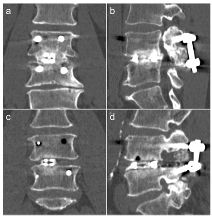 European Radiology：如何利用影像学评估接受椎间融合术患者的融合状态？