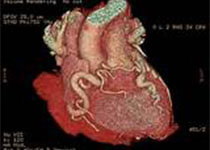 Cardiovasc Diabetol：糖尿病患者接受冠状动脉<font color="red">造影</font>时继续使用二甲双胍的安全性评估