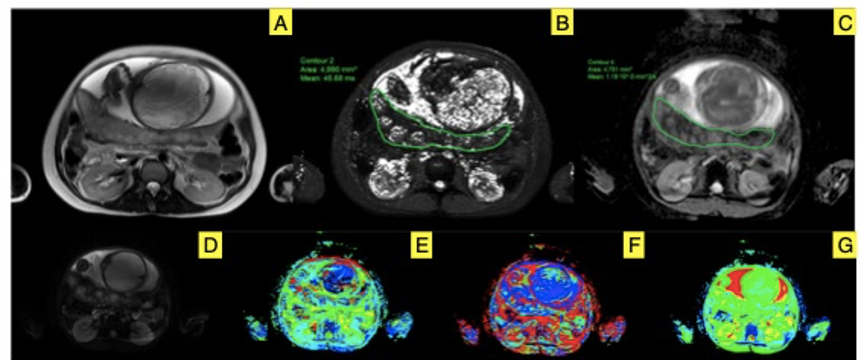 European Radiology：如何用影像学方法鉴别胎儿生长受限和小胎龄？