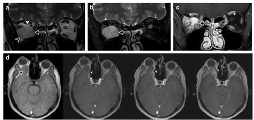 European Radiology：结构性<font color="red">MRI</font><font color="red">特征</font>如何准确表征眼眶海绵静脉畸形？
