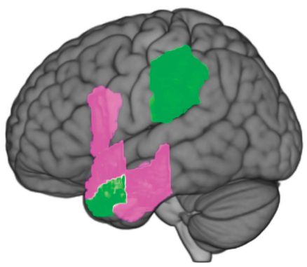 NEUROLOGY：原发性进行性失语症局部萎缩与命名能力<font color="red">下降</font>有关