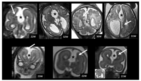 European Radiology：胎儿MR中的胼胝体完全发育不全和单侧皮质形成异常