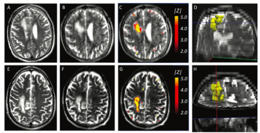 Radiology：基于超分辨率机器学习的便携式低场强<font color="red">MRI</font>测量