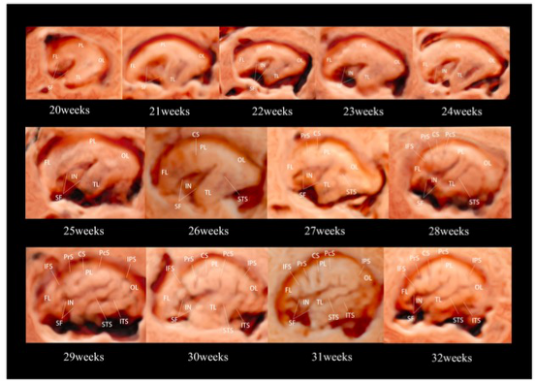 European Radiology：<font color="red">三维</font>晶体Vue<font color="red">成像</font>在正常妊娠20-32+6周胎儿大脑侧裂评估中的应用