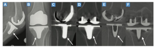 Radiology：双能量CT在检测膝关节假体松动方面的价值