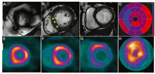 Radiology：18F-FAPI <font color="red">PET</font>/CT心肌活性在预测肥厚性心肌病心源性猝死方面的价值
