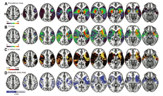 Radiology：急性脑卒中机械取<font color="red">栓</font>反应的MRI不匹配评估