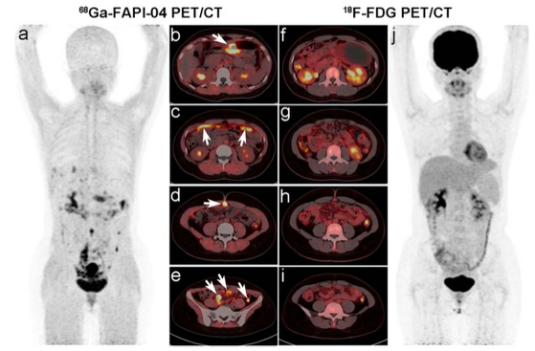 European Radiology：检测<font color="red">胃肠道</font><font color="red">恶性肿瘤</font>原发和转移灶的影像学检查